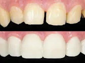 Tooth Bonding