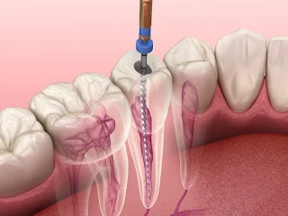 Root Canal Treatment (RCT)