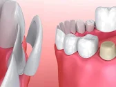 Veneers & Cosmetic Smile Designing